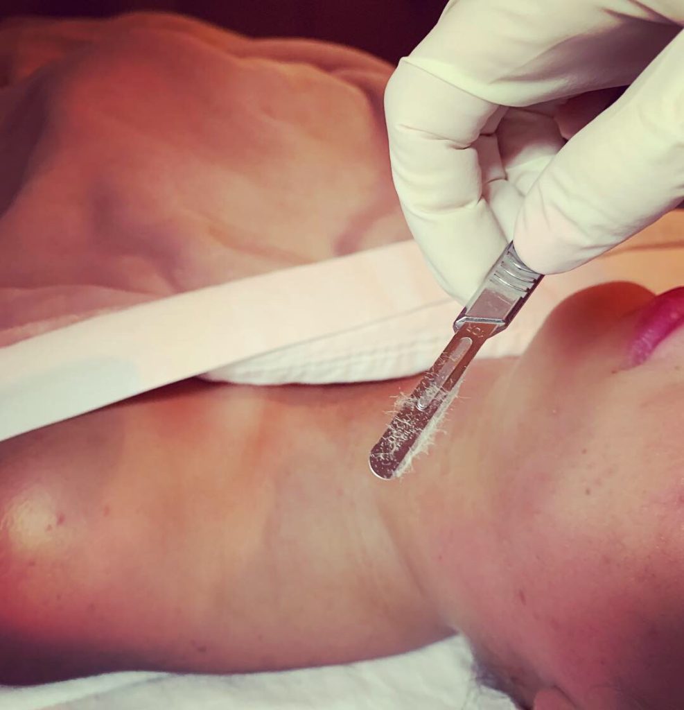 dermaplaning